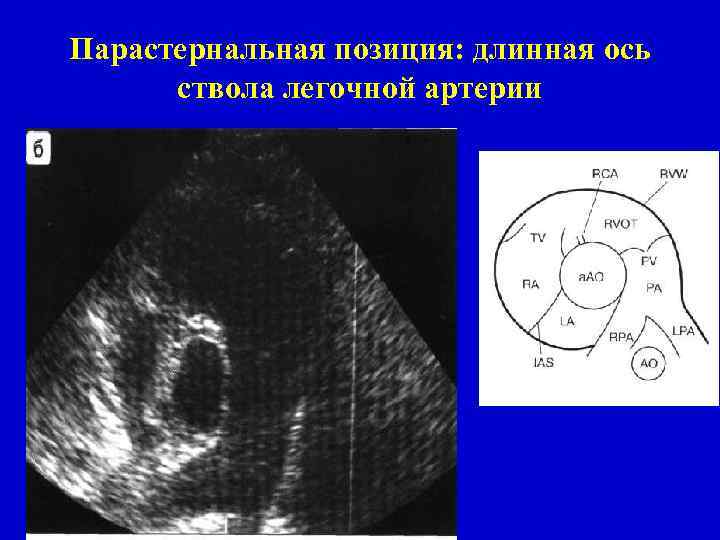 Длинная ось. Парастернальная позиция длинная ось ствола легочной артерии. Длинная парастернальная позиция. Парастернальная позиция по длинной оси. Парастернальная позиция длинная ось.