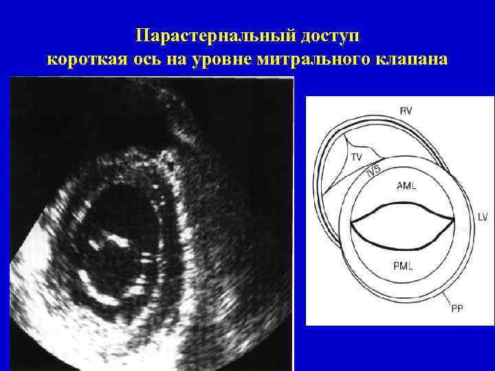 Парастернальный доступ короткая ось на уровне митрального клапана 