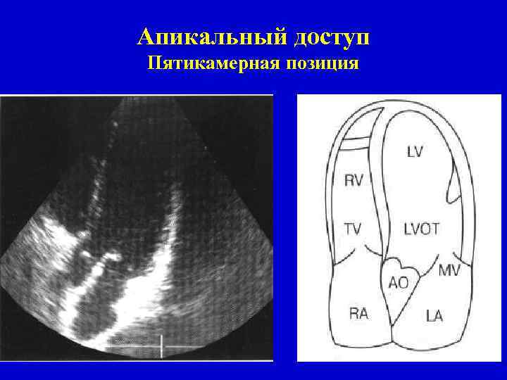 Апикальный доступ Пятикамерная позиция 