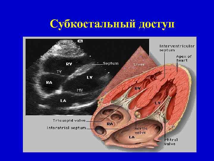 Субкостальный доступ 