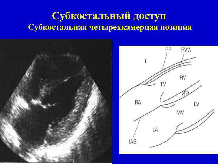Субкостальный доступ Субкостальная четырехкамерная позиция 