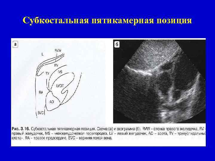 Субкостальная пятикамерная позиция 