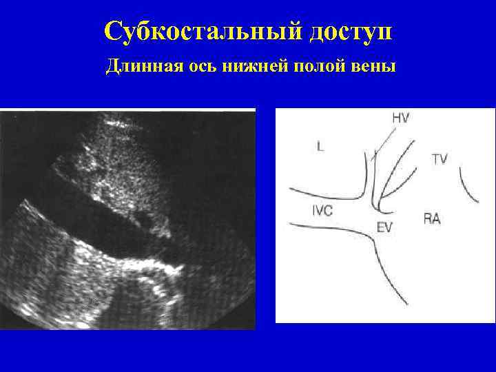 Субкостальный доступ Длинная ось нижней полой вены 