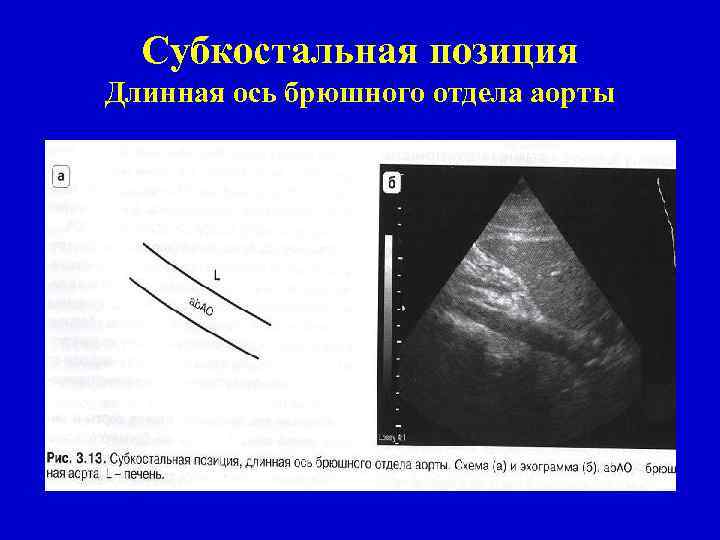 Субкостальная позиция Длинная ось брюшного отдела аорты 