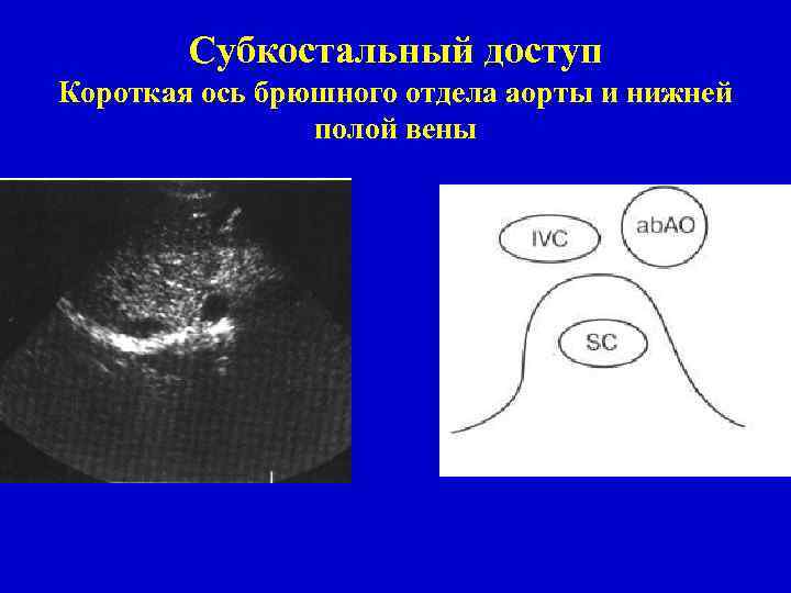 Субкостальный доступ Короткая ось брюшного отдела аорты и нижней полой вены 