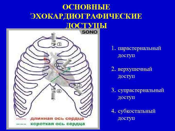 ОСНОВНЫЕ ЭХОКАРДИОГРАФИЧЕСКИЕ ДОСТУПЫ 1. парастернальный доступ 2. верхушечный доступ 3. супрастернальный доступ 4. субкостальный