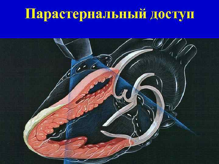 Парастернальный доступ 