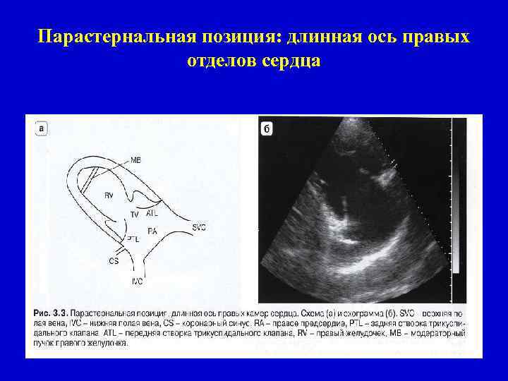 Правая ось. УЗИ парастернальная позиция длинная. ЭХОКГ правая парастернальная позиция. Парастернальная позиция длинная ось ЭХОКГ. Парастернальная позиция длинная ось левого желудочка.