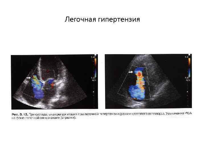 Легочная гипертензия 