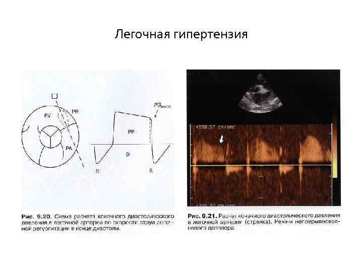 Легочная гипертензия 