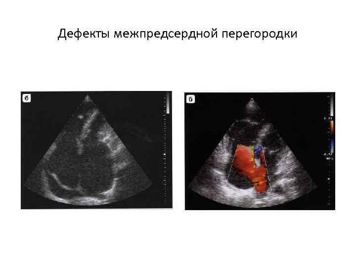 Дефекты межпредсердной перегородки 