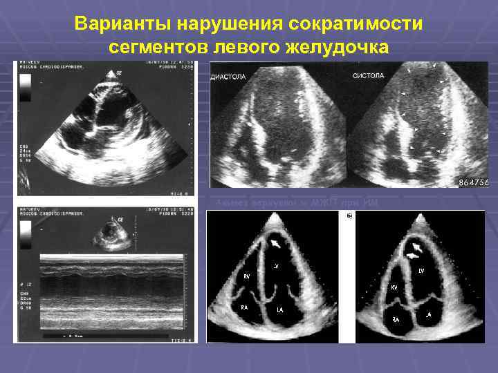 Варианты нарушения сократимости сегментов левого желудочка Акинез верхушки и МЖП при ИМ Гипокинез задней