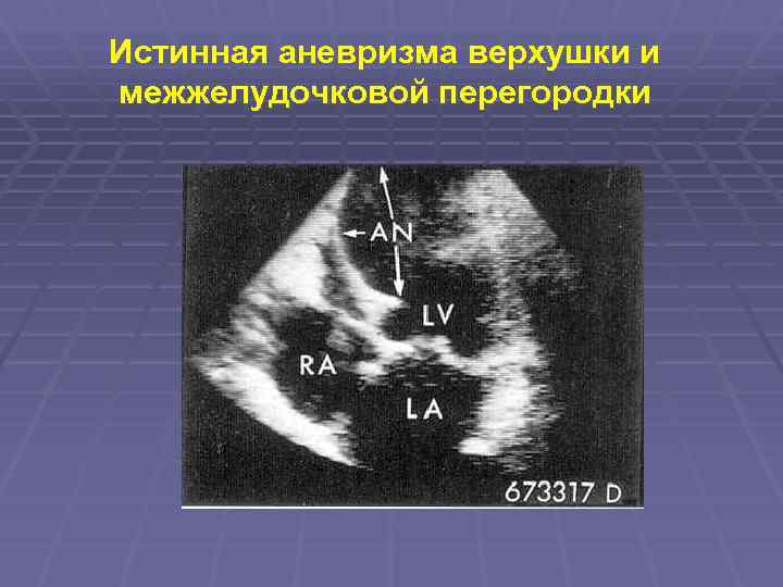 Истинная аневризма верхушки и межжелудочковой перегородки 