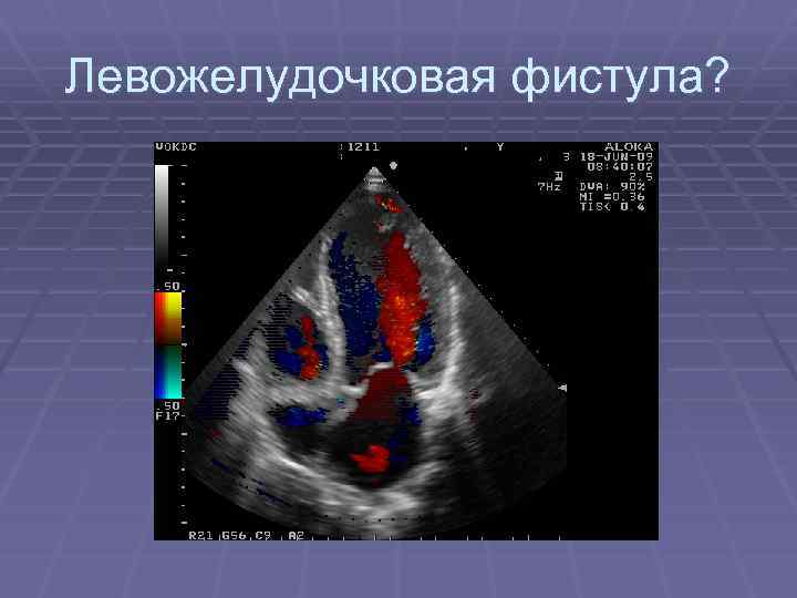 Левожелудочковая фистула? 
