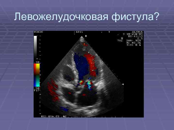 Левожелудочковая фистула? 