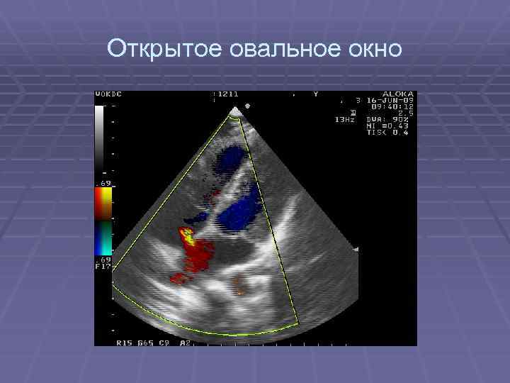 Открыто овальное окно у сердце ребенка