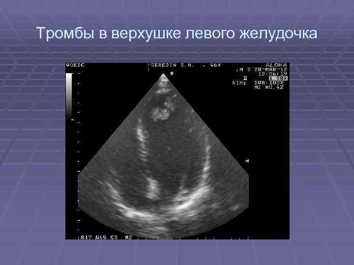 Тромбы в верхушке левого желудочка 