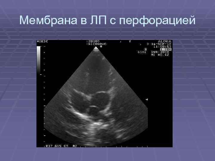 Мембрана в ЛП с перфорацией 