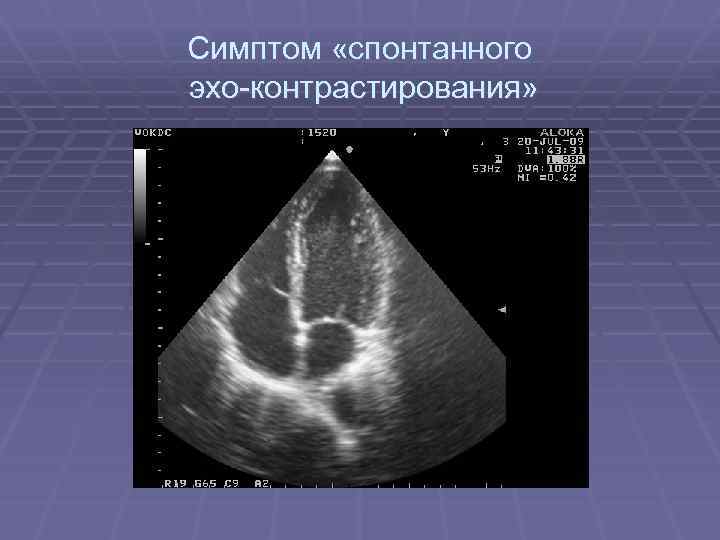 Симптом «спонтанного эхо-контрастирования» 