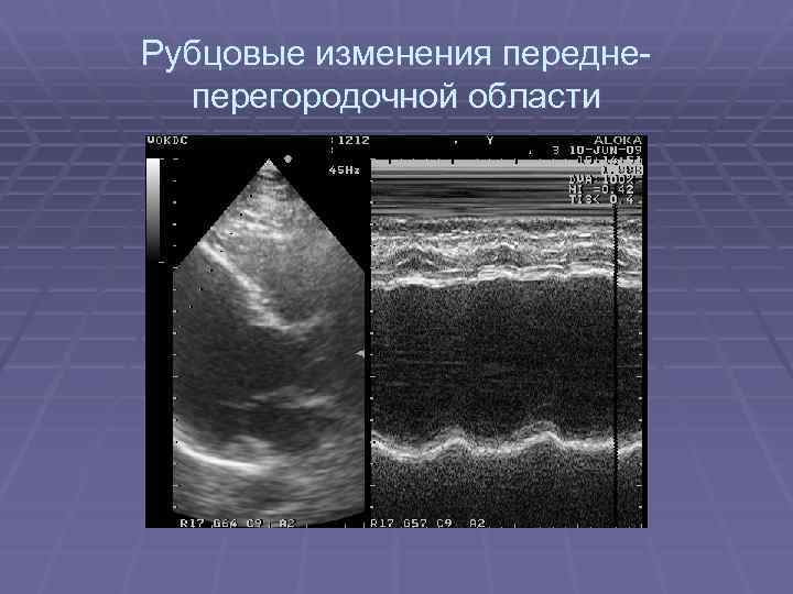 Рубцовые изменения. Рубцовые изменения передне-перегородочной области. Очаговые рубцовые изменения передне-перегородочной области. Рубцовые изменения миокарда передне перегородочной области. Передний перегородочный рубцовые изменения.