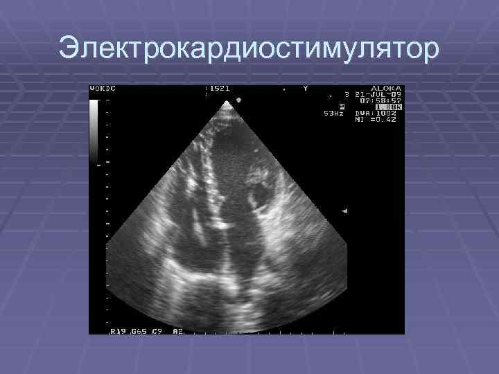 Электрокардиостимулятор 