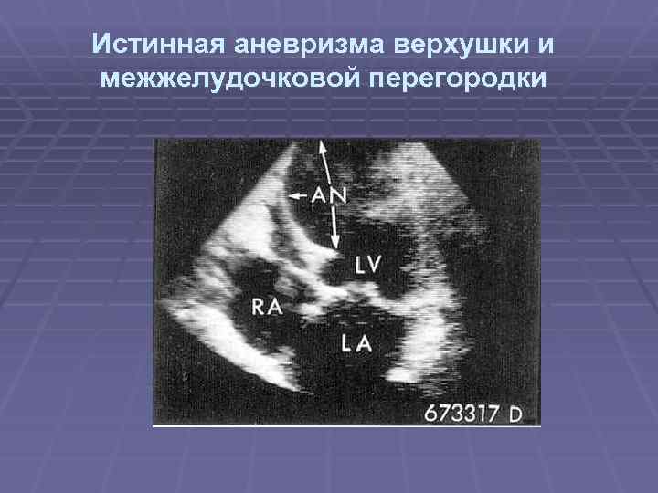 Истинная аневризма верхушки и межжелудочковой перегородки 