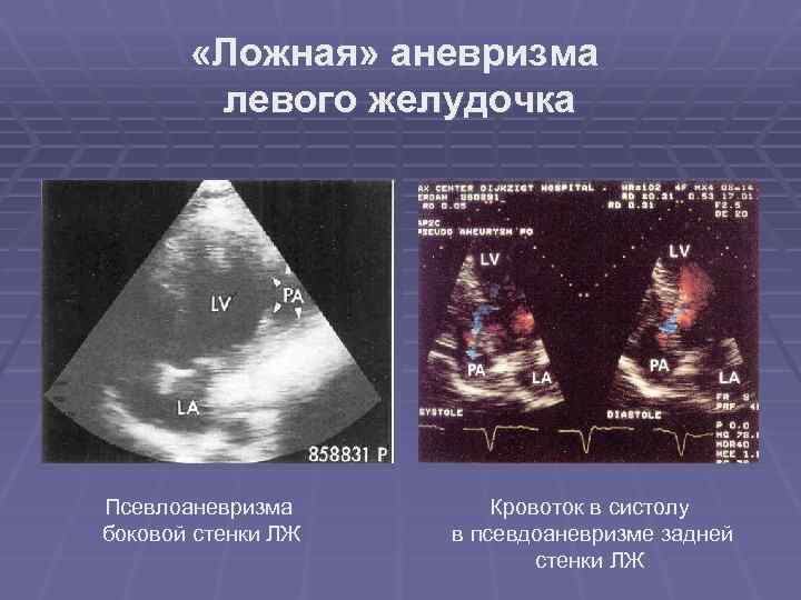 Диарея на фоне острого псевдомембранозного энтероколита