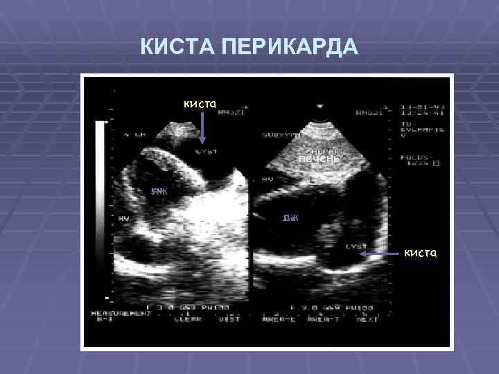 КИСТА ПЕРИКАРДА киста печень лж лж киста 