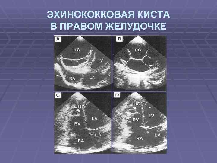 Эхинококковая киста печени в ультразвуковом изображении характеризуется