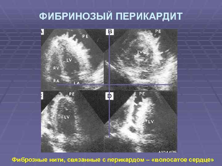 ФИБРИНОЗЫЙ ПЕРИКАРДИТ Фиброзные нити, связанные с перикардом – «волосатое сердце» 
