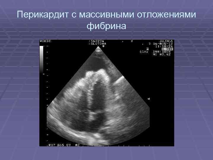 Перикардит с массивными отложениями фибрина 