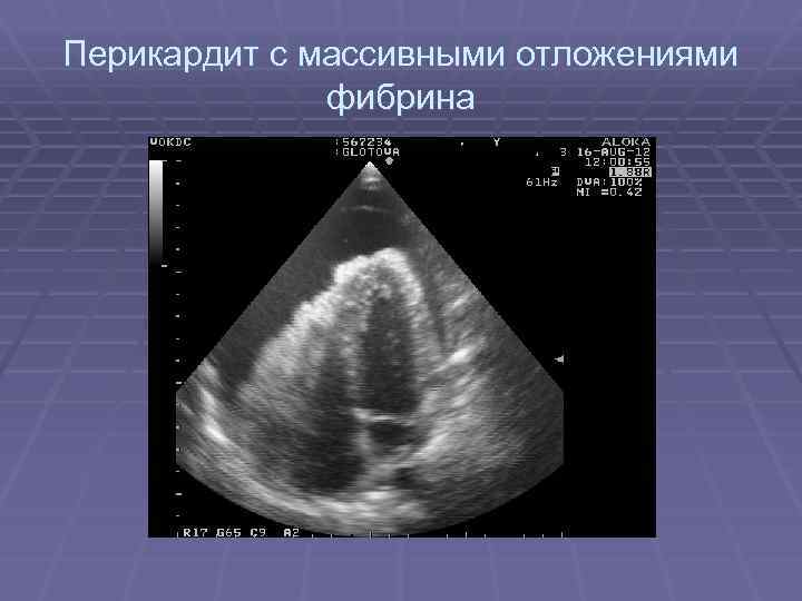 Жидкость в перикарде. Экссудативный перикардит эхокардиография. Гидроперикард на ЭХОКГ. Перикардит эхокардиография.