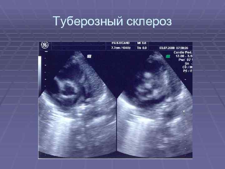 Туберозный склероз 