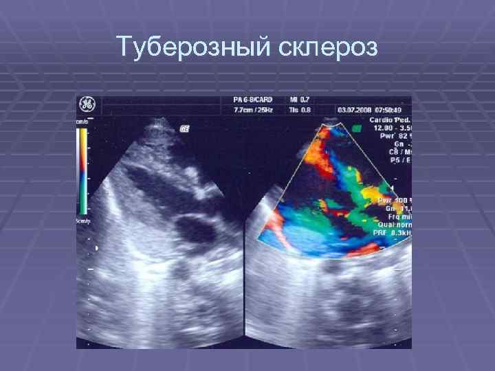 Туберозный склероз 