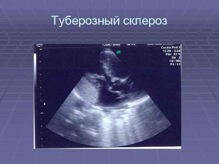 Туберозный склероз 