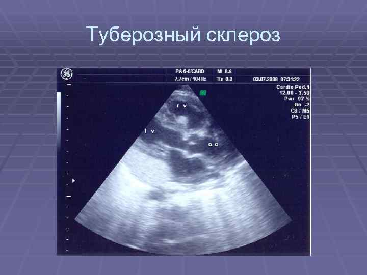 Туберозный склероз 