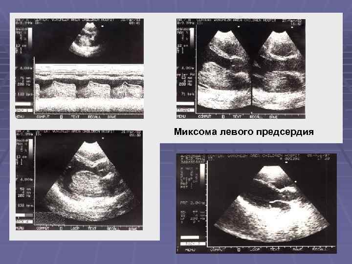 Миксома левого предсердия 