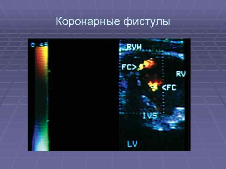 Коронарные фистулы 