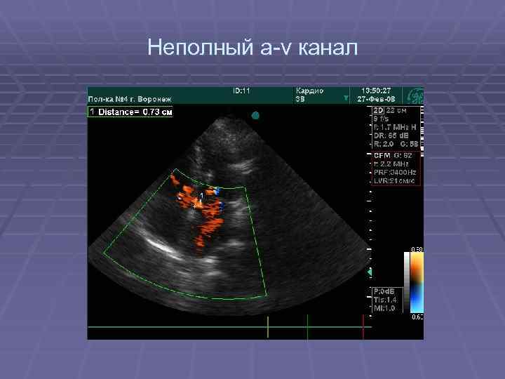 Неполный а-v канал 