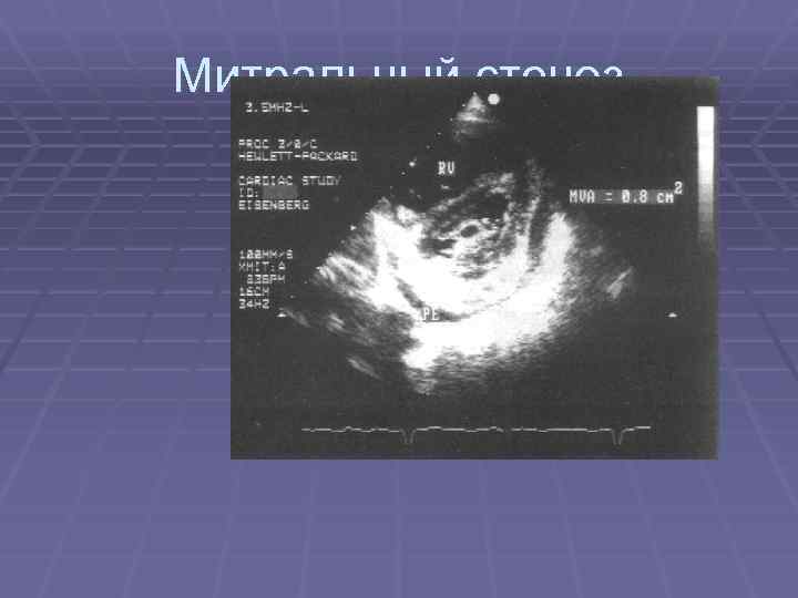 Митральный стеноз 