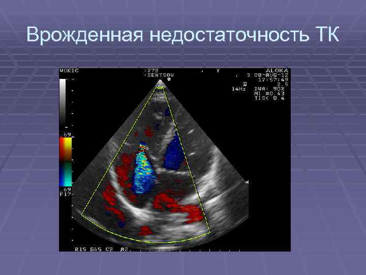 Врожденная недостаточность ТК 