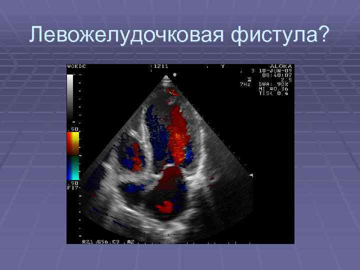 Левожелудочковая фистула? 