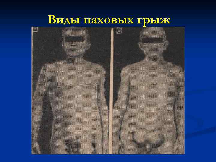 Виды паховых грыж 