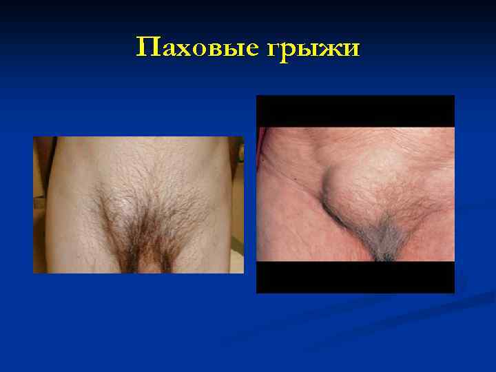 Паховые грыжи 