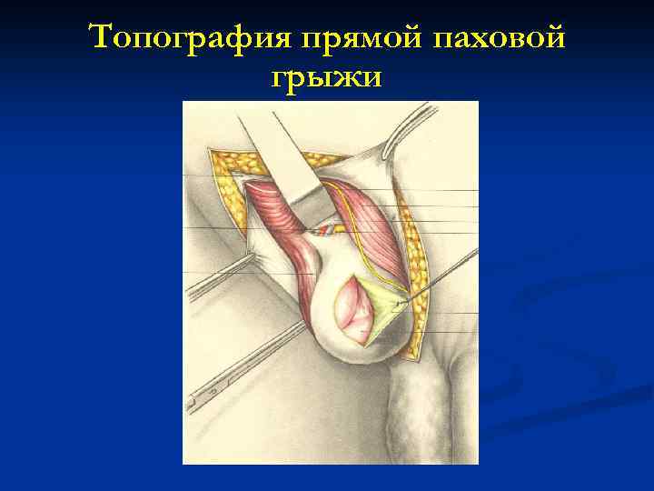 Топография прямой паховой грыжи 