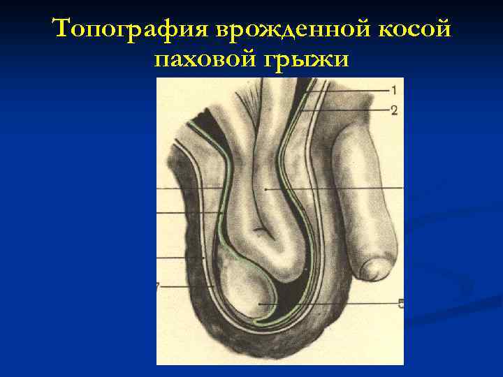 Топография врожденной косой паховой грыжи 