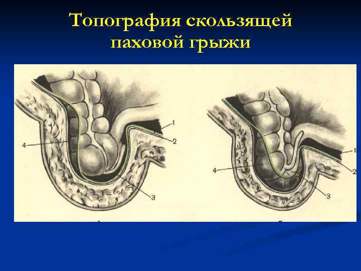 Топография скользящей паховой грыжи 