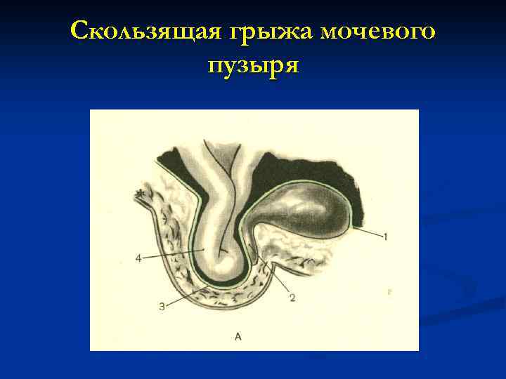 Ущемленная грыжа хирургия презентация