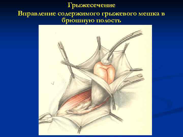 Грыжесечение Вправление содержимого грыжевого мешка в брюшную полость 
