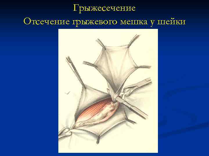 Грыжесечение Отсечение грыжевого мешка у шейки 